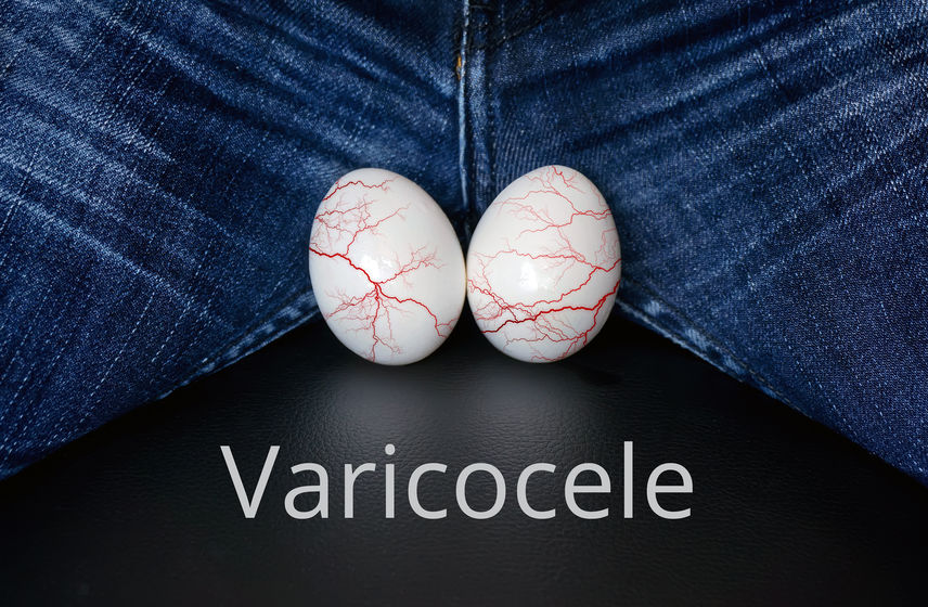 Alerta: varicocele é a principal causa de infertilidade masculina